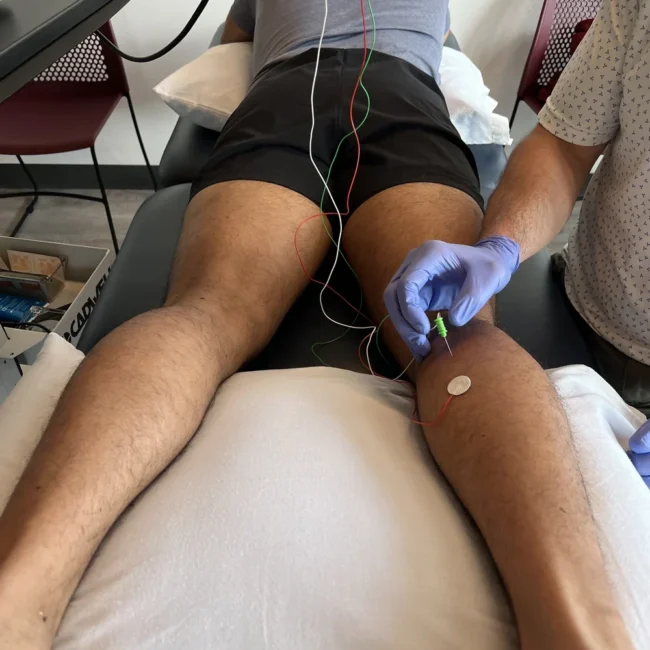 EMG electrode placement on leg for nerve testing Chicago