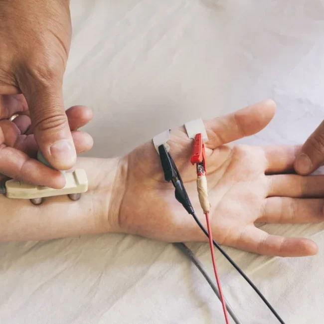 nerve conduction testing on hand with electrode clips Chicago