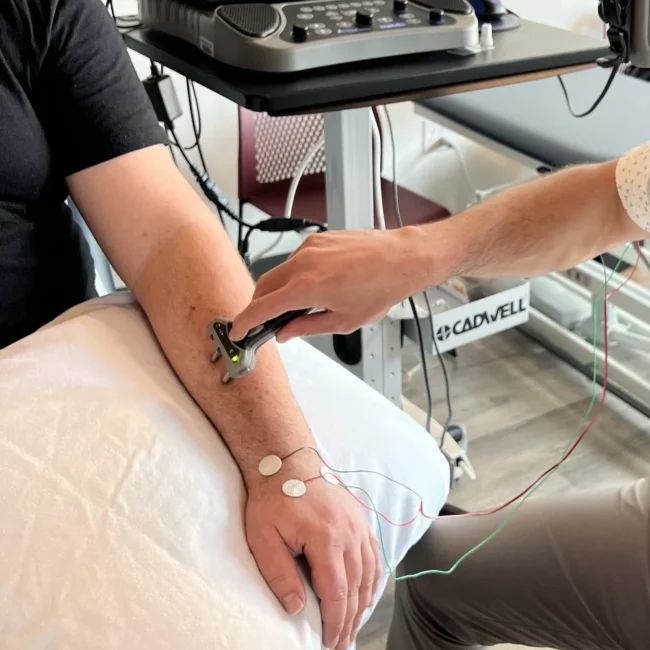 nerve stimulation device used during NCV test on arm Chicago